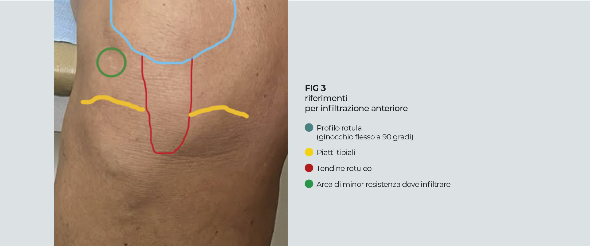 FIG 3 riferimenti per infiltrazione anteriore