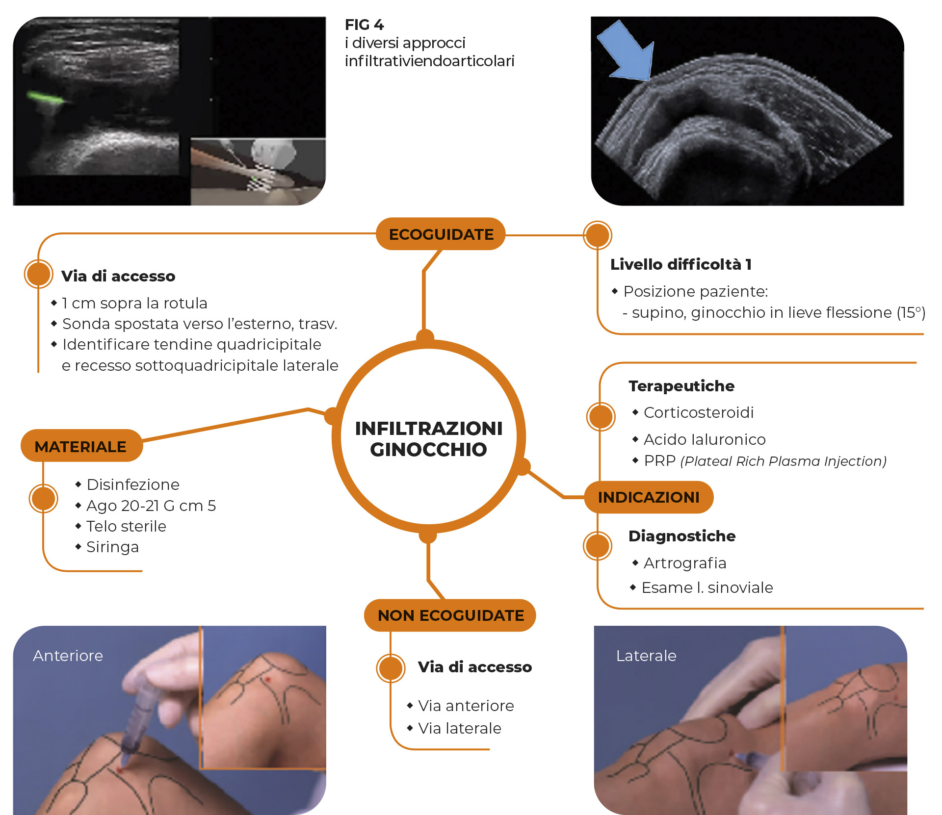 FIG 4 i diversi approcci infiltrativi endoarticolari